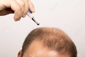 Baldness Alopecia man hair loss isolated
